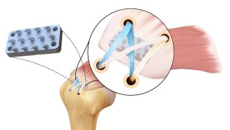 An illustrated diagram of the python-inspired device placed in the shoulder between the head of an arm bone and the tendon in the rotator cuff. The illustration features a closeup on the connection.